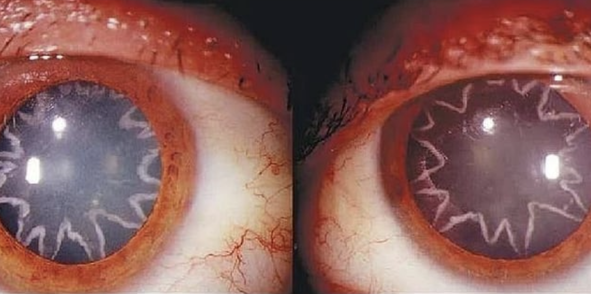 Eyes of an electrician after being shocked by 15,000 volts.