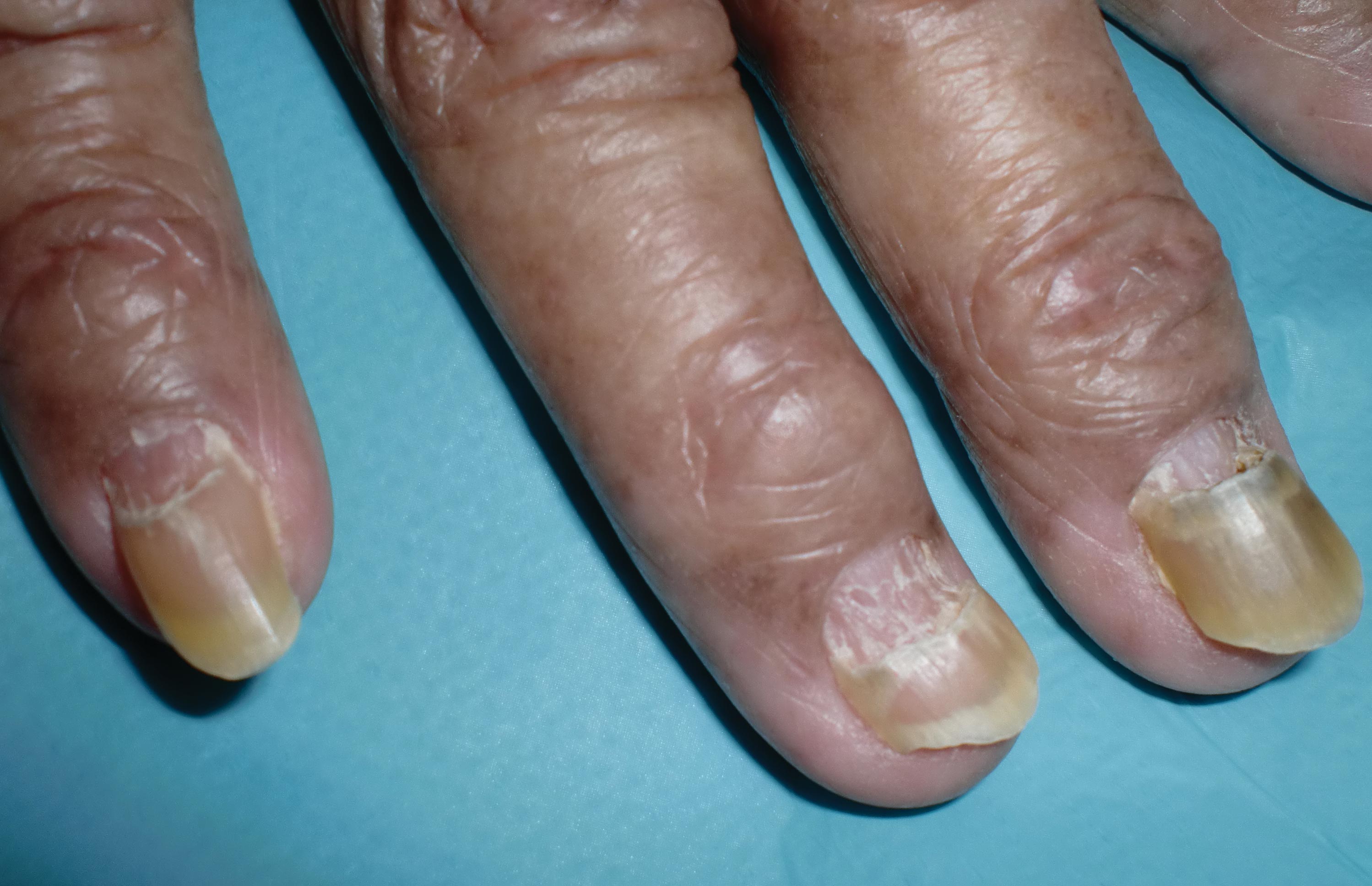 There is an urban myth that your fingernails continue to grow after death, which is supposed to explain why dead bodies often appear to have long nails.<br><br>The truth is that the soft tissues in the fingers and hands tend to contract as they lose moisture, leading to the appearance of growing nails. -Draculamb