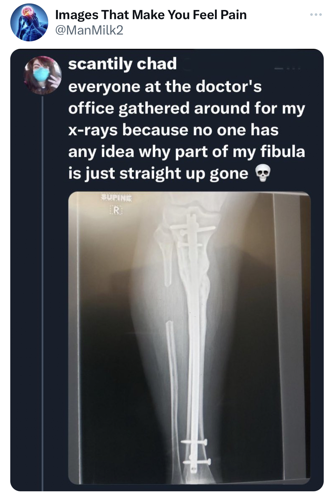 savage tweets - x ray - Images That Make You Feel Pain scantily chad everyone at the doctor's office gathered around for my xrays because no one has any idea why part of my fibula is just straight up gone Dupine