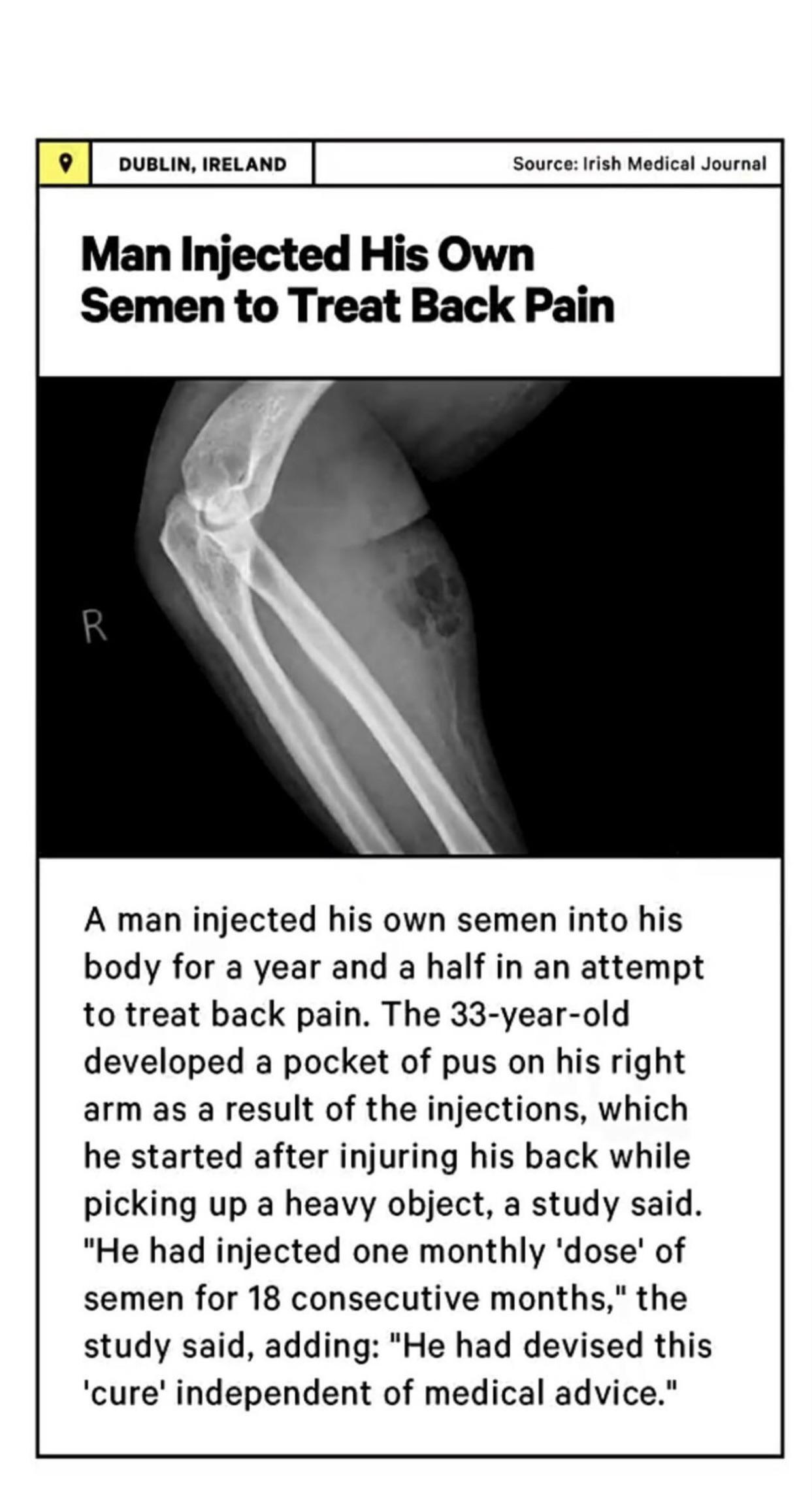 facepalm pics - arm - Dublin, Ireland Source Irish Medical Journal Man Injected His Own Semen to Treat Back Pain R A man injected his own semen into his body for a year and a half in an attempt to treat back pain. The 33yearold developed a pocket of pus o