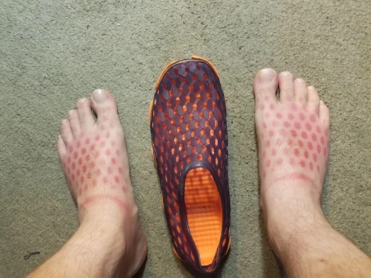 “When you forget to put sunscreen on your feet.”