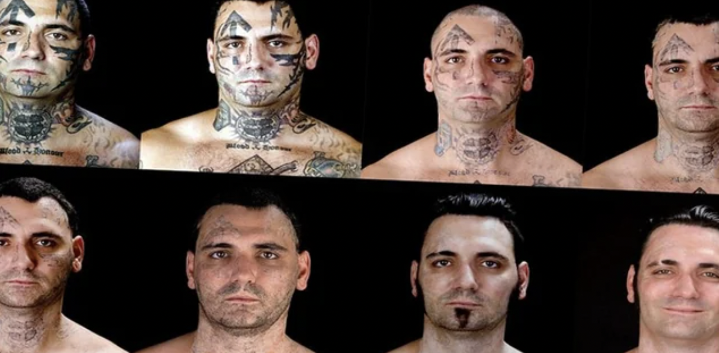 Reformed skinhead endures 25 surgeries over the course of 16 months to remove tattoos.
