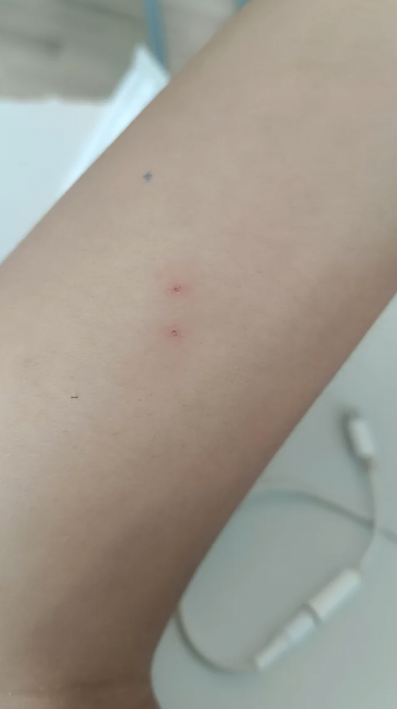 I keep getting these scars which are always two spots in this pattern when I wake up. Usually get it down my legs but today I got it on my arm.