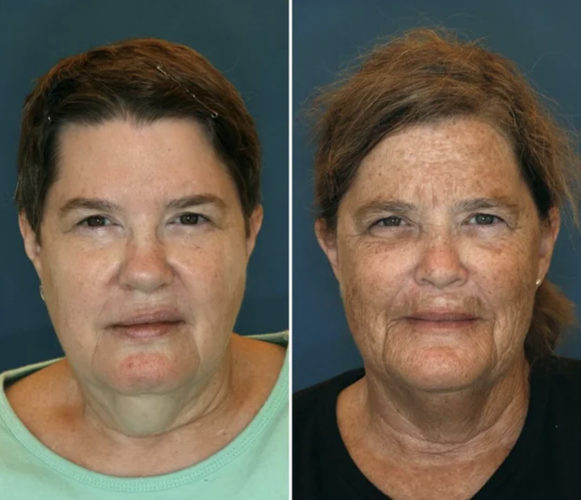 Identical twins at age 61: The one on the right was a sunbather and smoked for sixteen years.