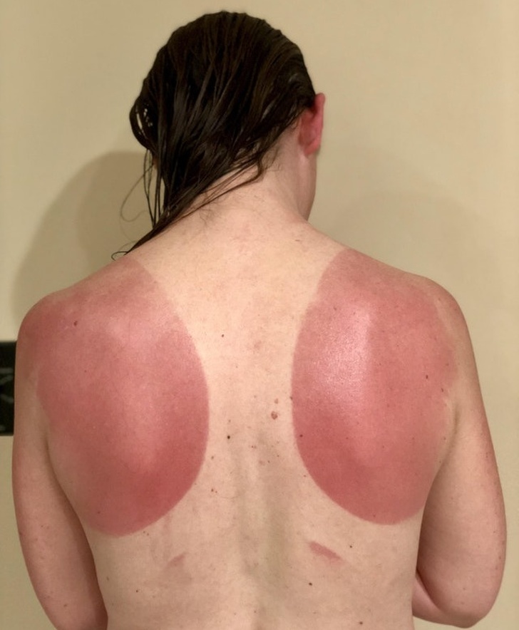 This is what happens when you ride a bike without applying sunscreen when it's 100°F outside.
