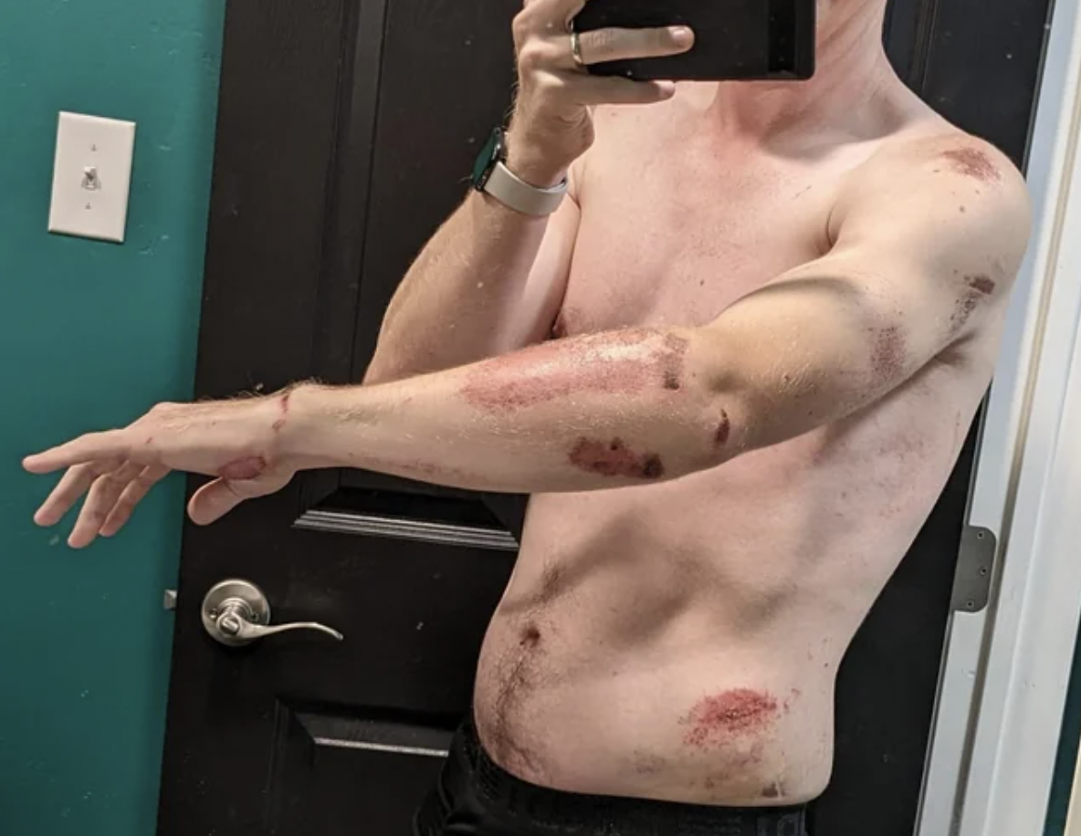 “Fell off my ebike going 25 mph onto the concrete.”