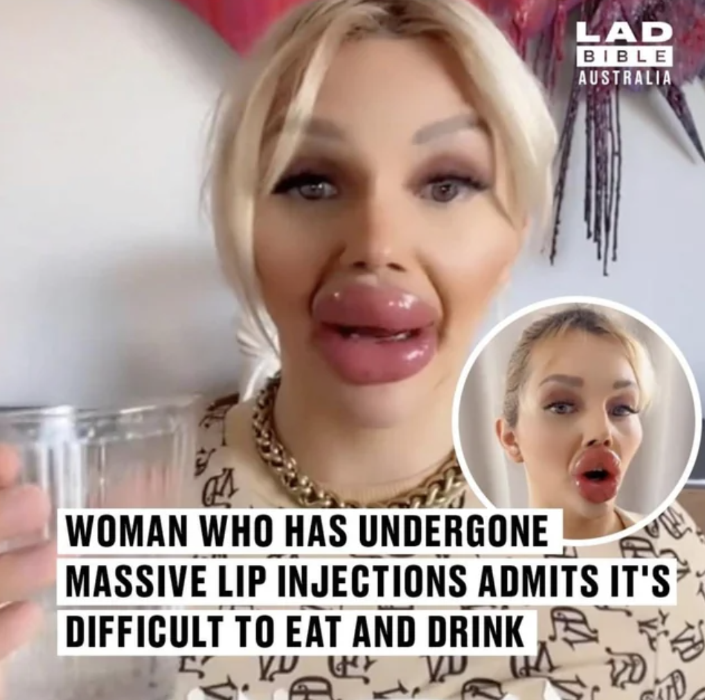 lip - Lad Bible Australia Woman Who Has Undergone Massive Lip Injections Admits It'S E Difficult To Eat And Drink 5 Vu wer Vu