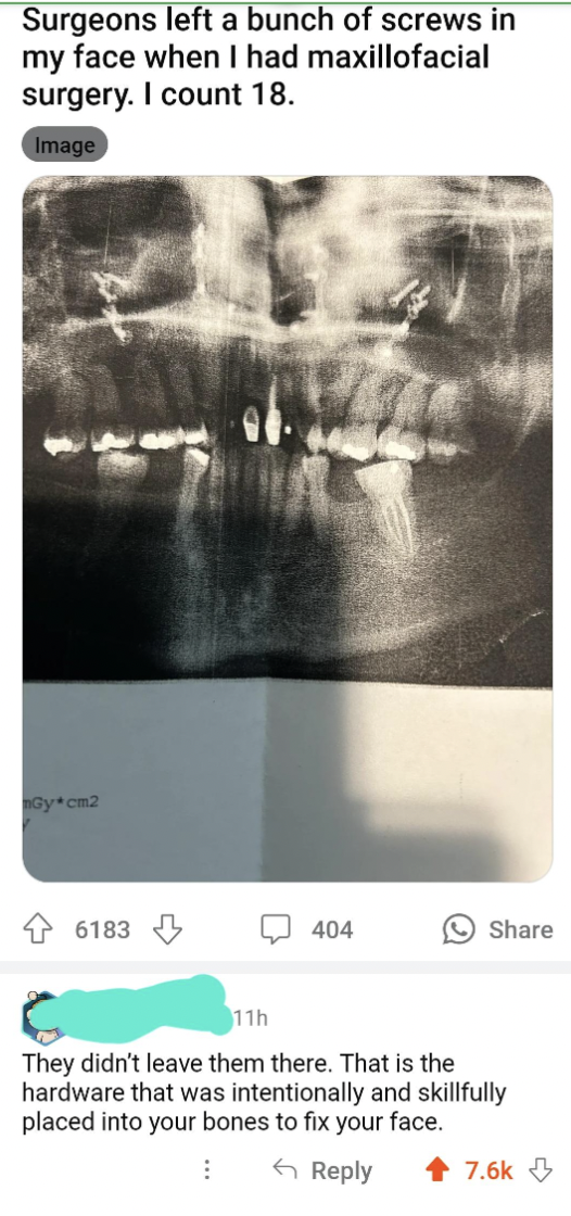 jaw - Surgeons left a bunch of screws in my face when I had maxillofacial surgery. I count 18. Image 6183 404 11h They didn't leave them there. That is the hardware that was intentionally and skillfully placed into your bones to fix your face. E