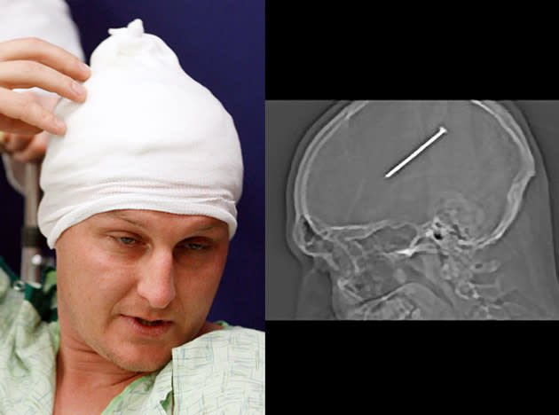 In January 2012, a man named Dante Autullo accidentally shot a 3.5-inch nail directly into his brain while working in his garage, unaware that he had just done so. The nail wasn't surgically removed until 36 hours later when an X-ray scan of his head stunned about a dozen extremely surprised doctors.