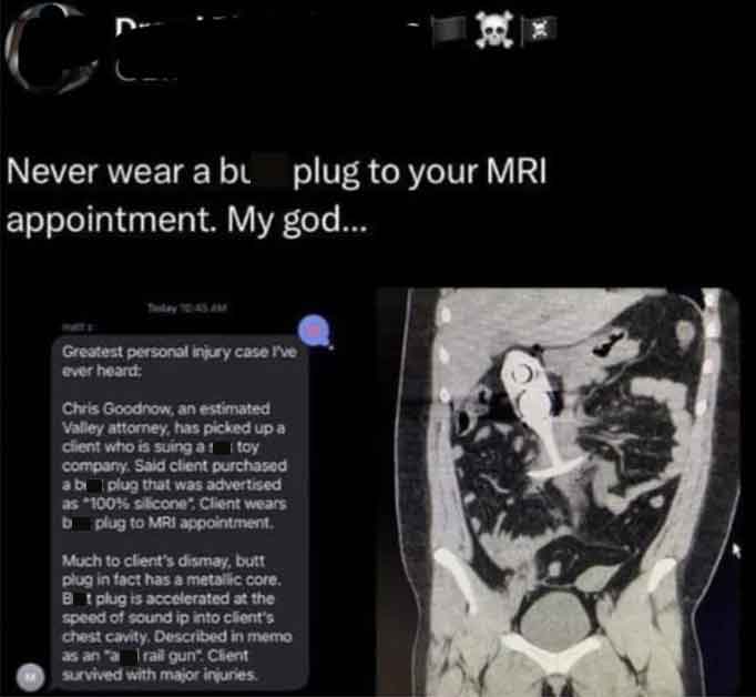 plug mri - Never wear a bu plug to your Mri appointment. My god... Greatest personal injury case I've ever heard Chris Goodnow, an estimated Valley attorney, has picked up a client who is suing at itoy company. Said client purchased a bi plug that was adv