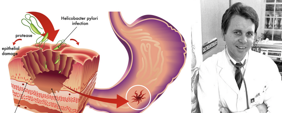 gastric ulcer shape - protease epithelial damage Helicobacter pylori infection Pastrentering