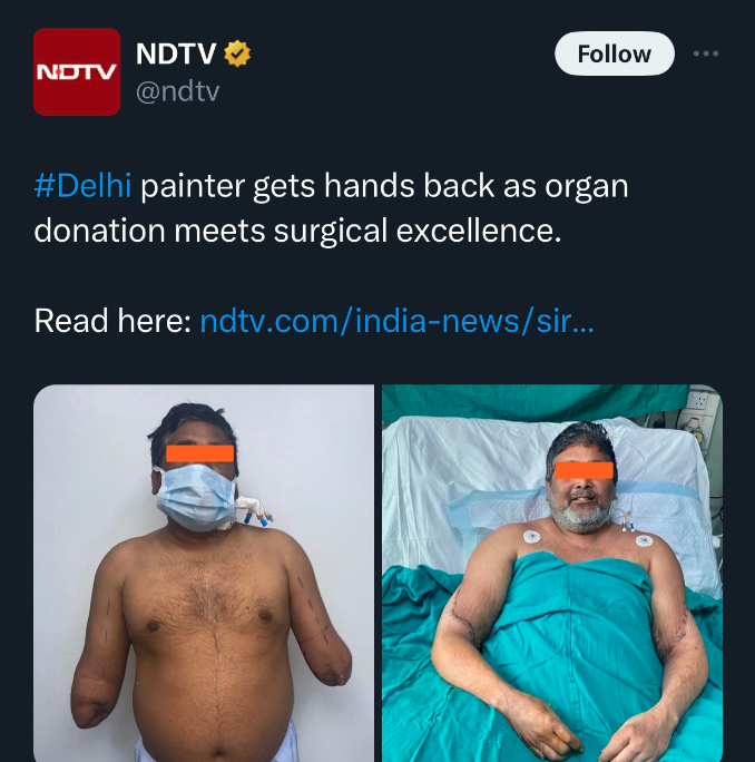 hand transplant india - Ndtv Ndtv painter gets hands back as organ donation meets surgical excellence. Read here ndtv.comindianewssir...