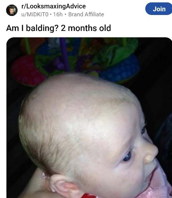baby - rLooksmaxingAdvice uMidkito 16h Brand Affiliate Am I balding? 2 months old Join