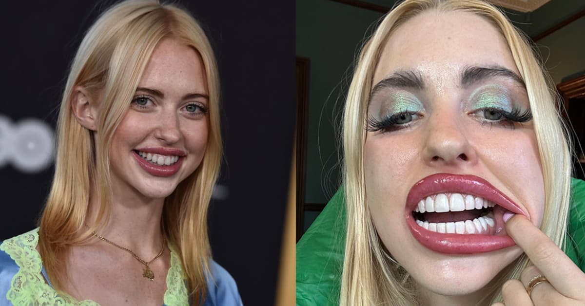 17 Celebs Before and After Veneers