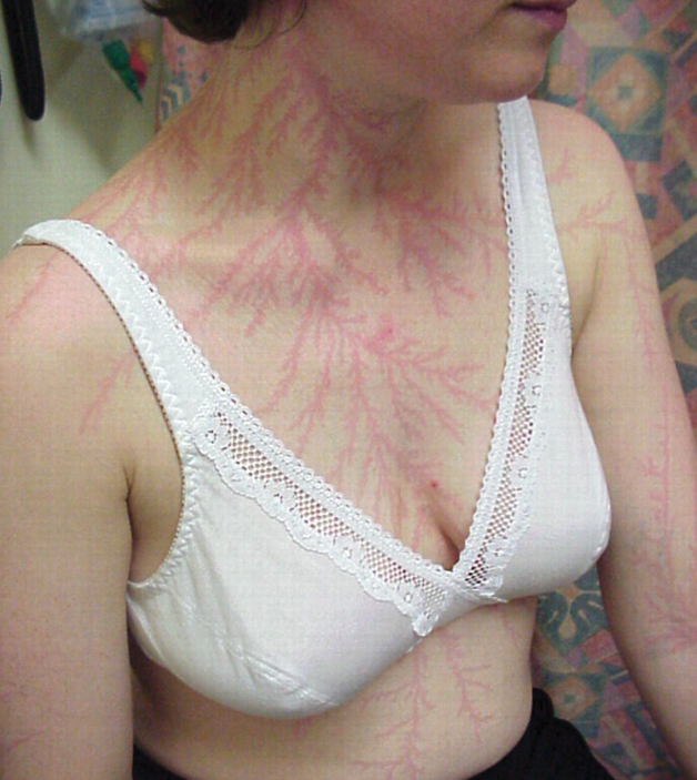 lichtenstein scars
