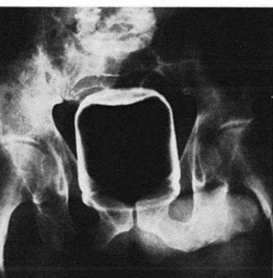 x ray of peanut butter