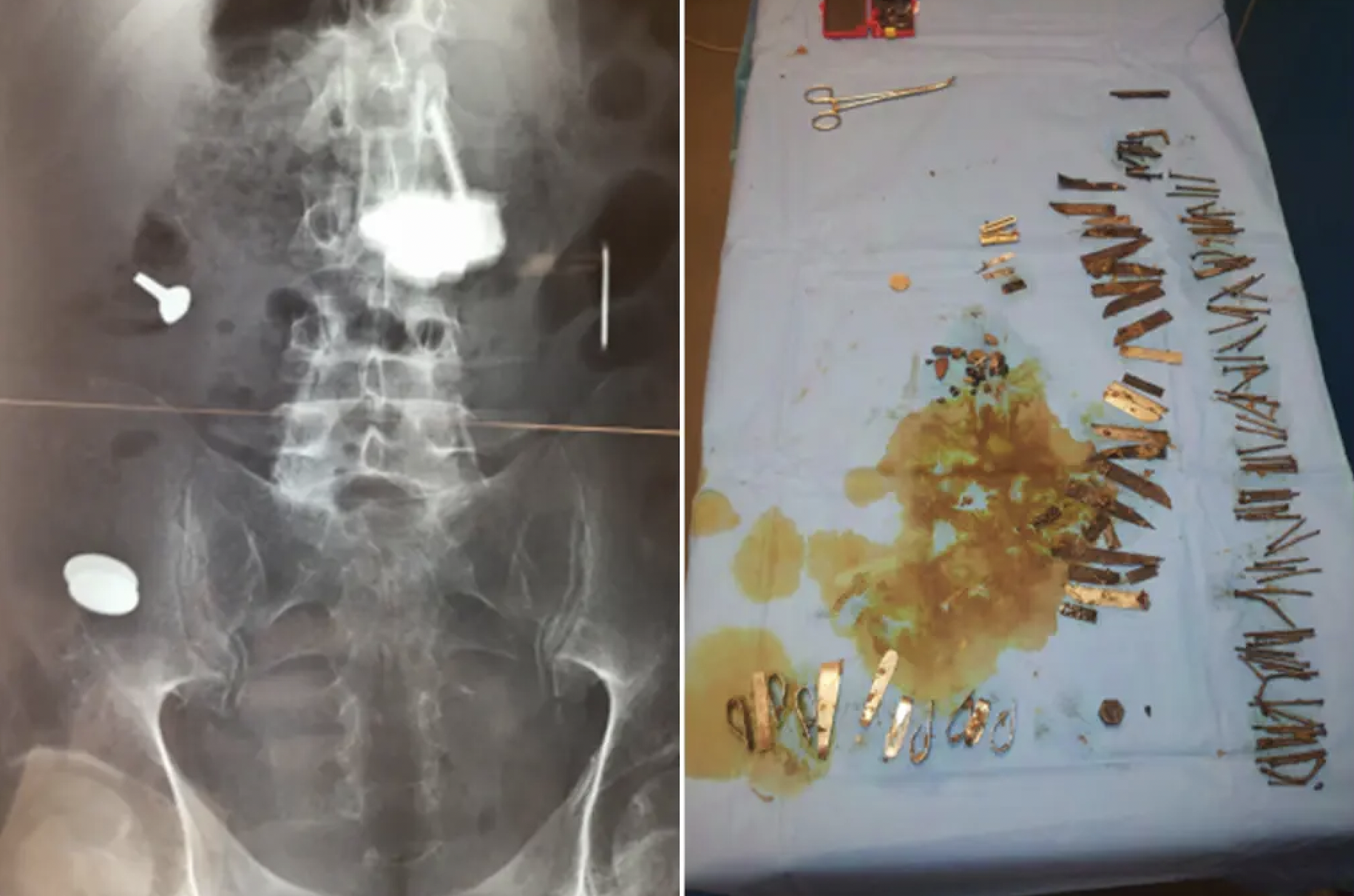 Surgeons remove nails, knives and screws from man’s stomach. He was suffering from chronic psychosis; a condition that manifests as a disconnection from reality.