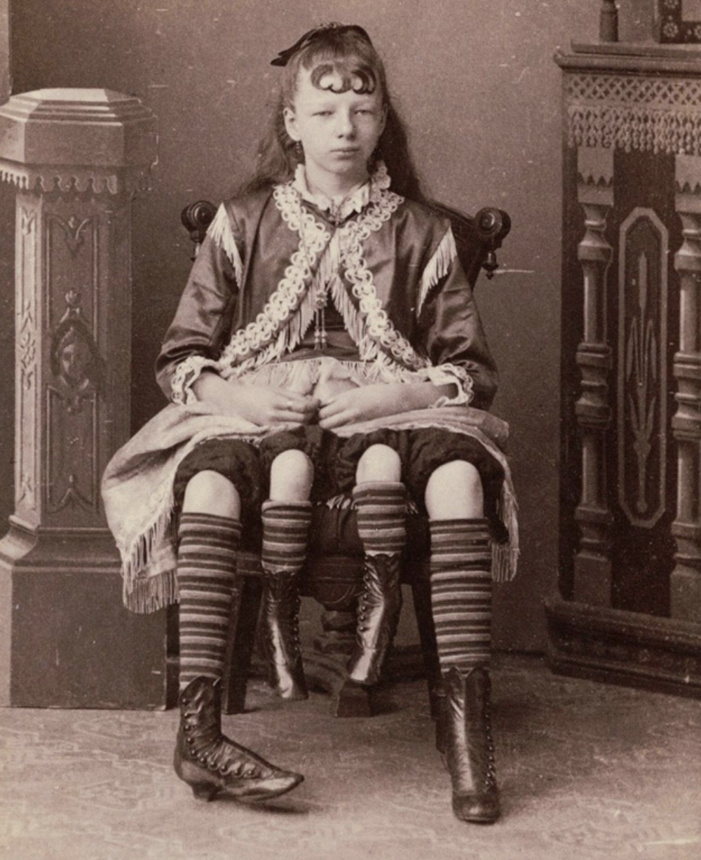Sideshow performer Myrtle Corbin had the ability to move all four of her legs. 