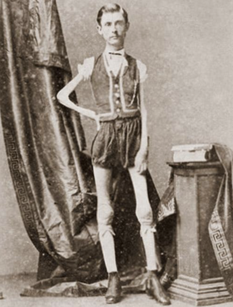 Isaac Sprague, “The Living Skeleton,” began losing weight at 12. He performed with P.T. Barnum before dying of asphyxia. 