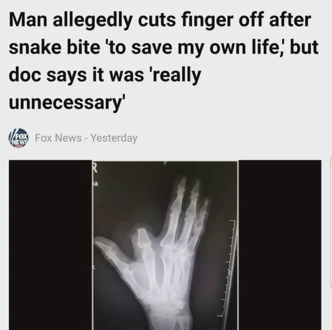 x-ray - Man allegedly cuts finger off after snake bite 'to save my own life, but doc says it was 'really unnecessary' Fox Fox News Yesterday