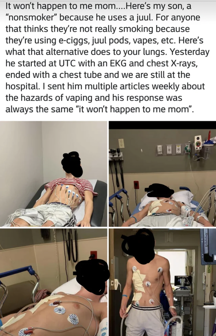patient - It won't happen to me mom....Here's my son, a "nonsmoker" because he uses a juul. For anyone that thinks they're not really smoking because they're using eciggs, juul pods, vapes, etc. Here's what that alternative does to your lungs. Yesterday h