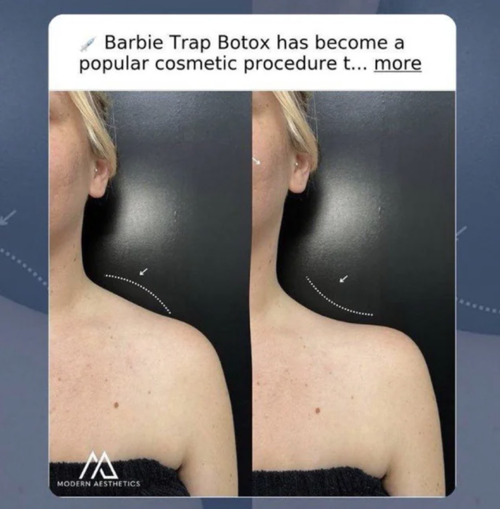 screenshot - Barbie Trap Botox has become a popular cosmetic procedure t... more Ma Modern Aesthetics