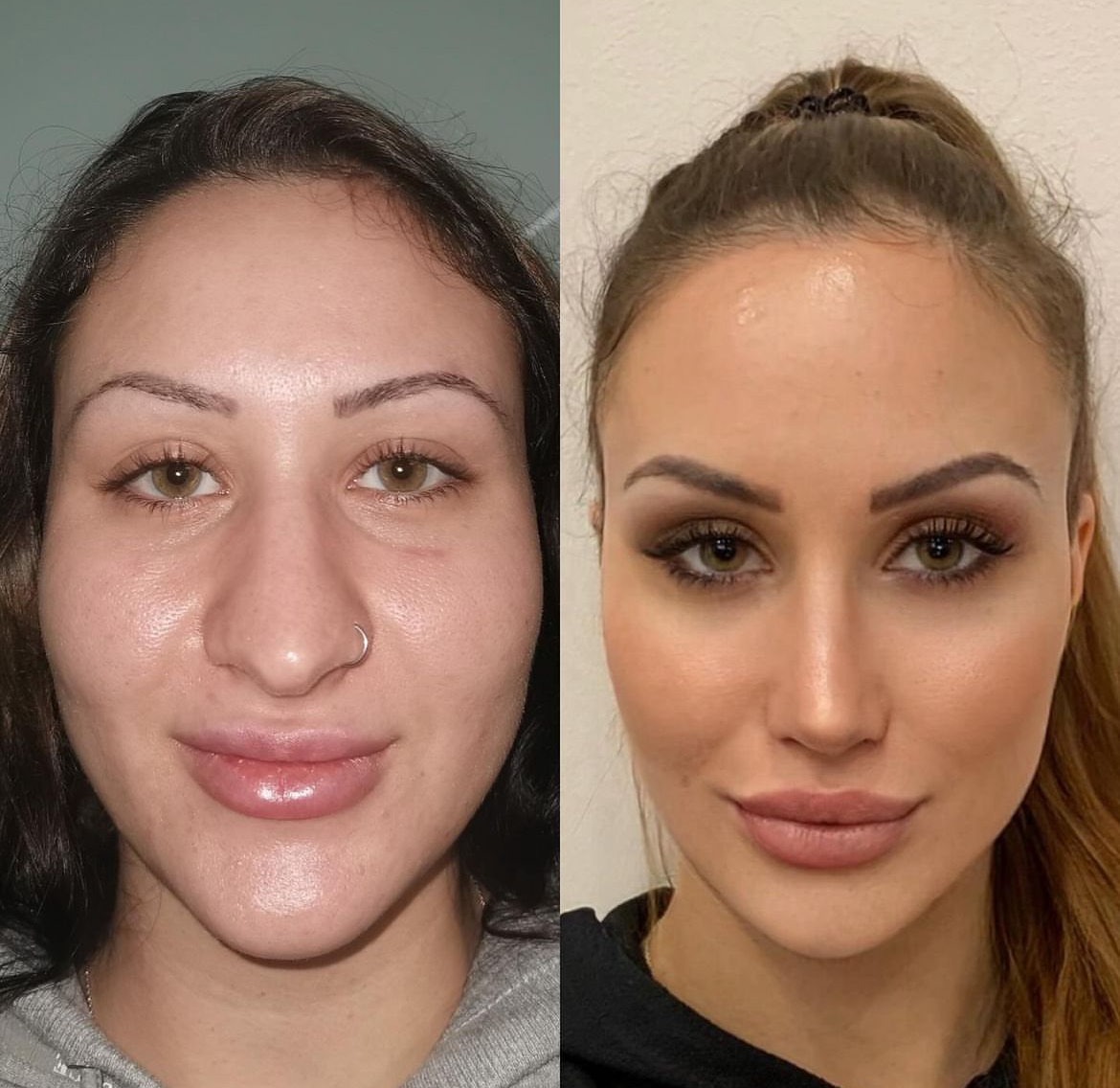 instagram plastic surgery before and after