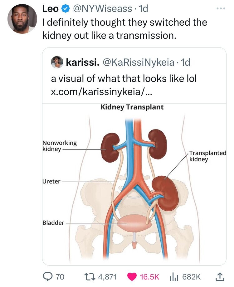 knee - Leo . 1d I definitely thought they switched the kidney out a transmission. karissi. Nykeia. 1d a visual of what that looks lol x.comkarissinykeia... Kidney Transplant Nonworking kidney Ureter Bladder Transplanted kidney 70 4,871