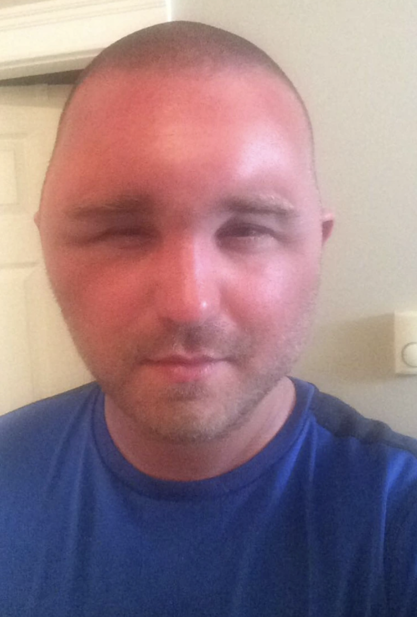 “Get a summer job out in the sun they said. It'll be fun they said. Doc said it's the worst swelling from a sunburn he's ever seen.”
