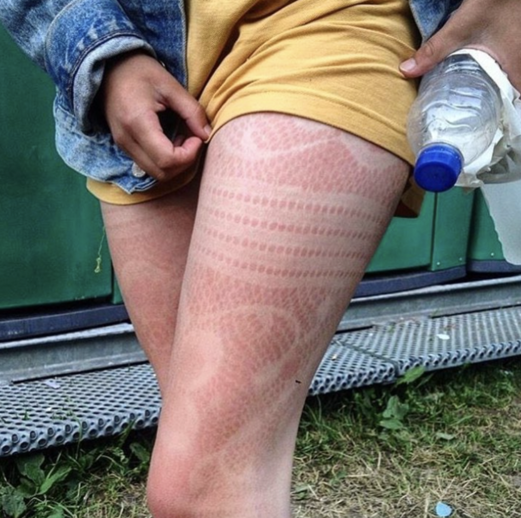 “Sunburn patterns from wearing stockings all day.”