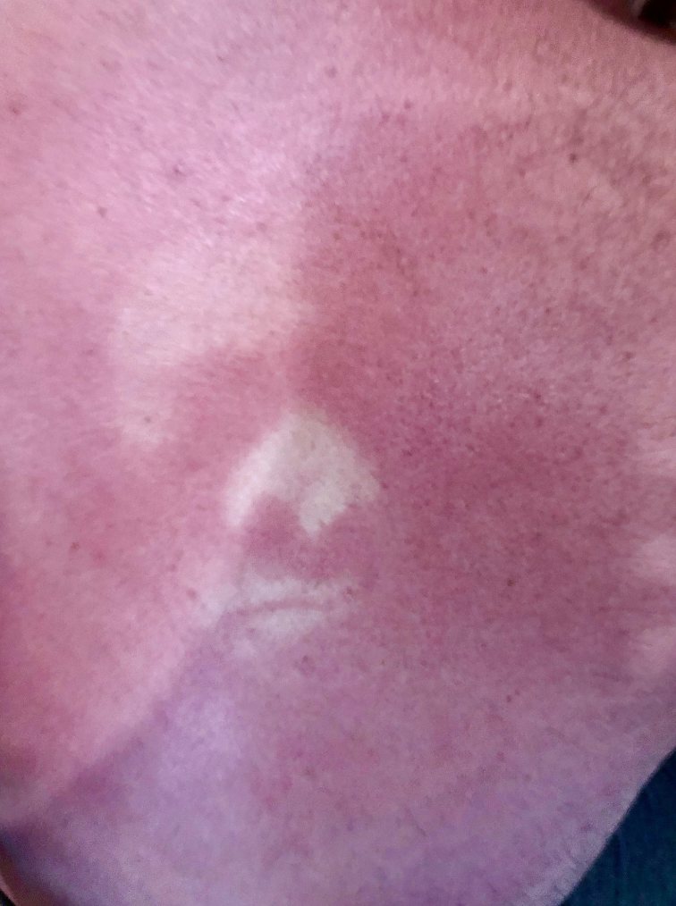 “Got a sunburn on my back. My daughter pressed her face into it and took a photo. Kids these days!”