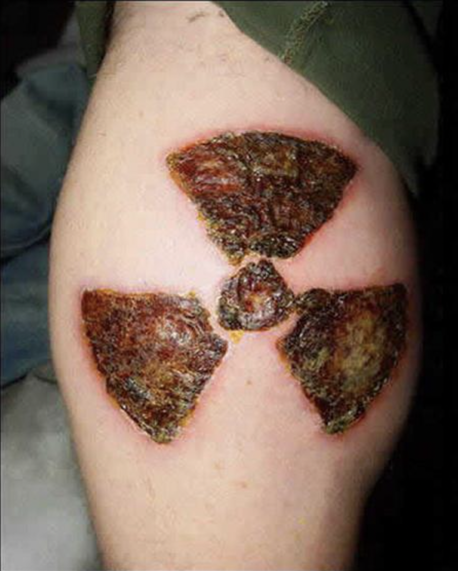 tattoo that looks like a burn
