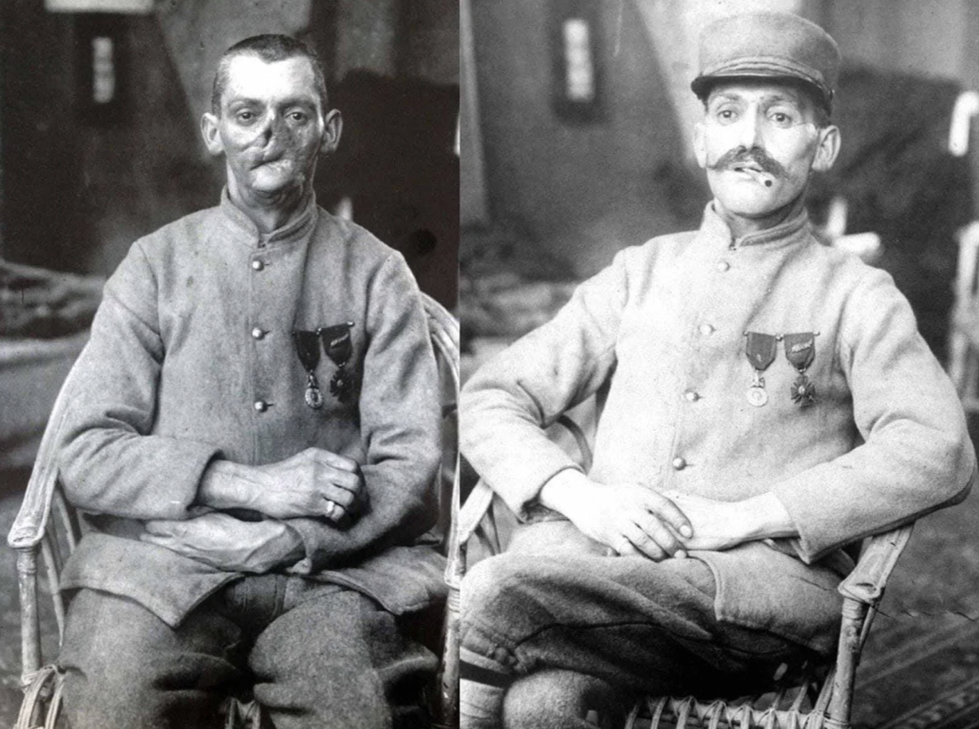 17 Harrowing WWI Soldier Being Fitted For Prosthetic Masks 