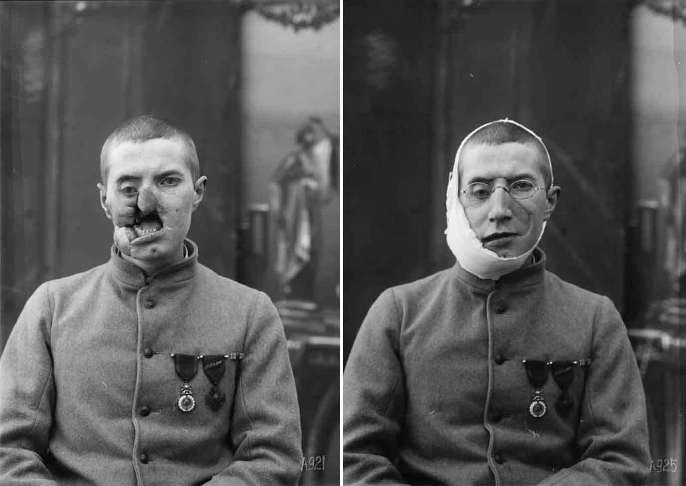 17 Harrowing WWI Soldier Being Fitted For Prosthetic Masks 