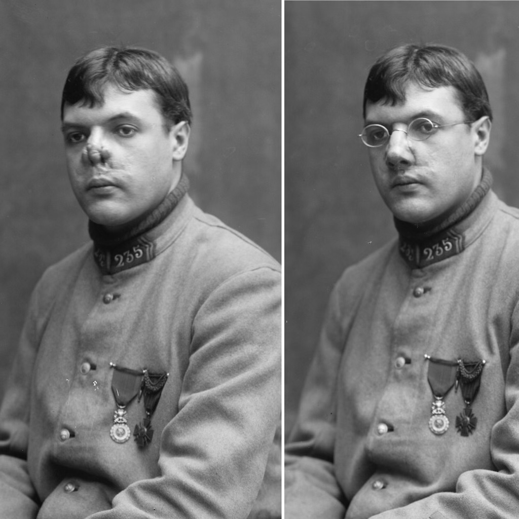 17 Harrowing WWI Soldier Being Fitted For Prosthetic Masks 