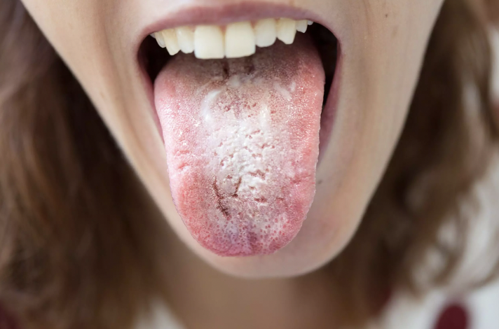 tongue infection