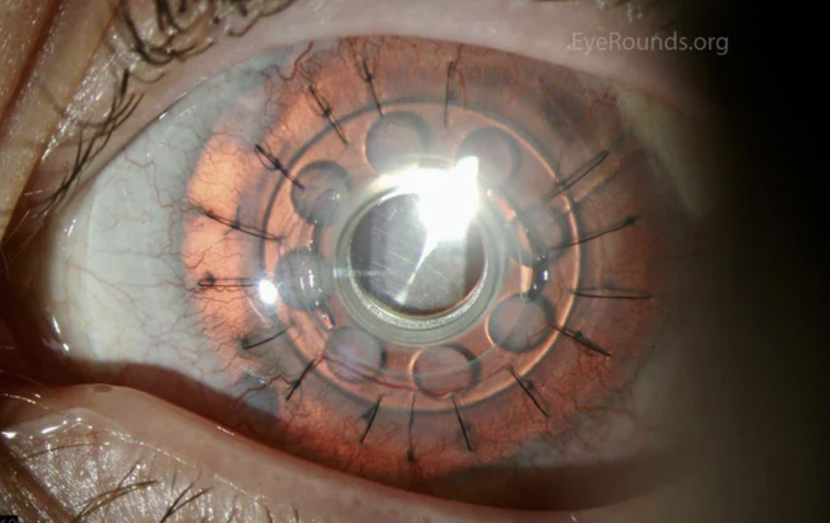 cornea artificial - EyeRounds.org