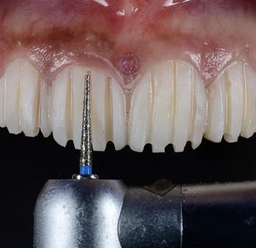 Preparation for veneers. 