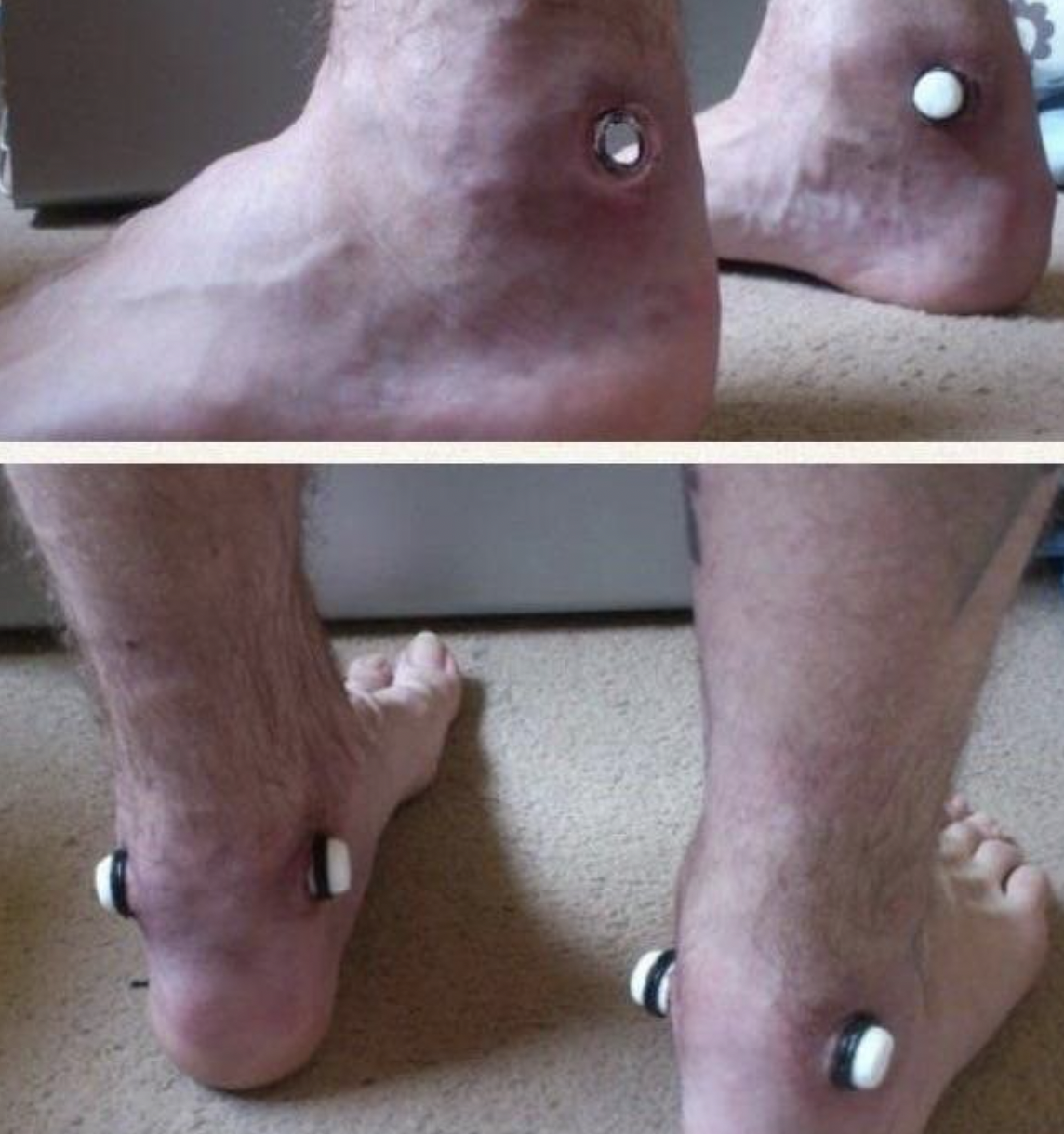 The “stretched achilles” modification.