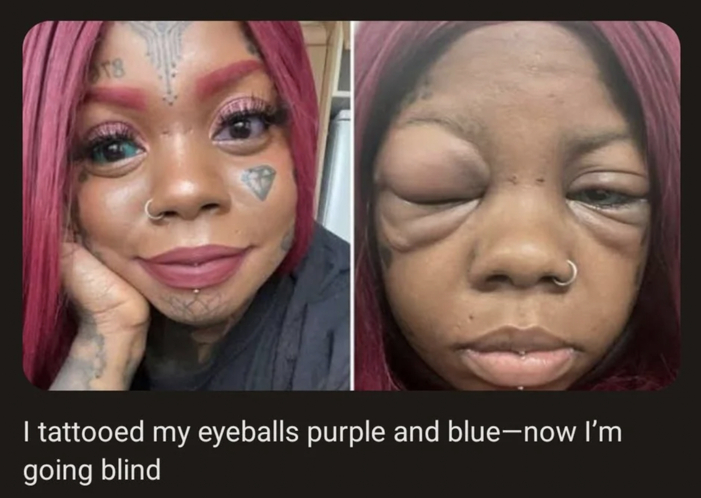 anaya peterson eyes - T8 tattooed my eyeballs purple and bluenow I'm going blind