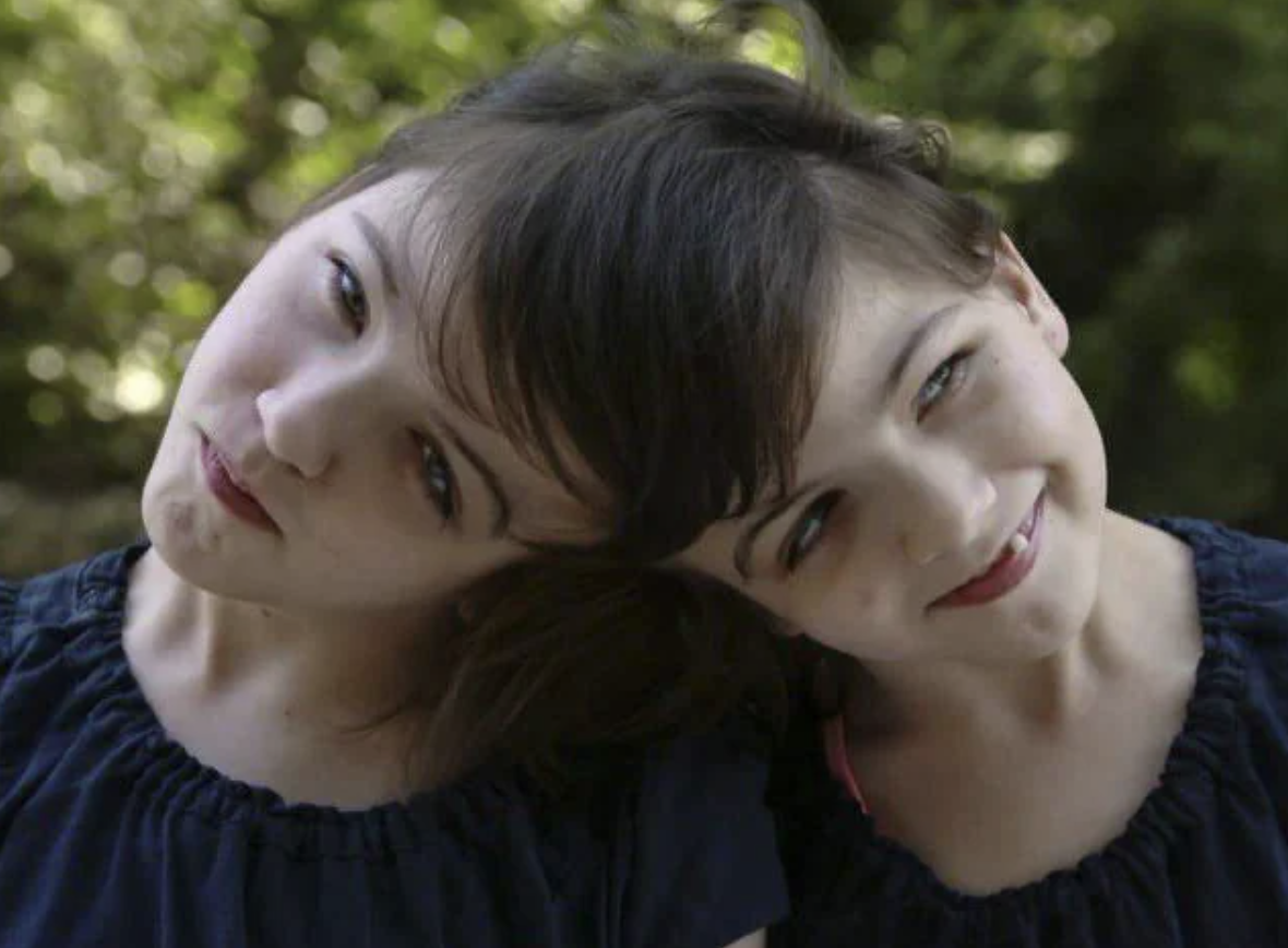 can conjoined twins hear each other's thoughts