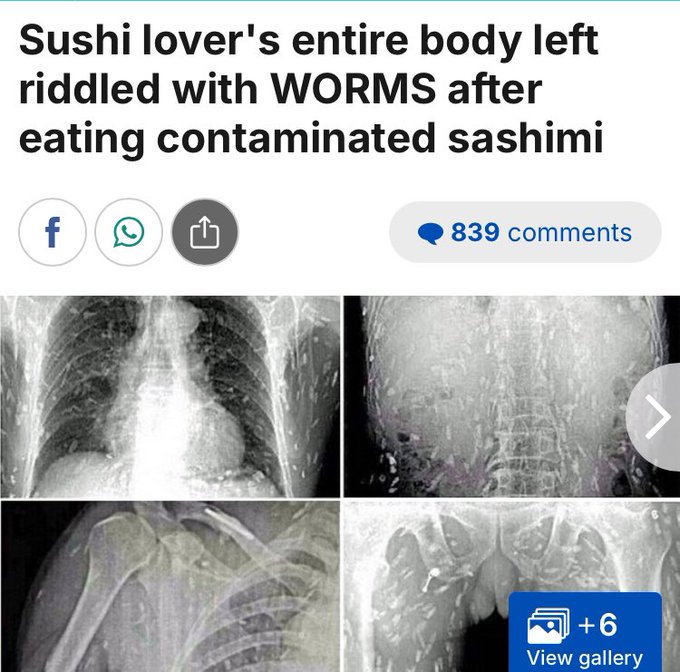 tapeworm infection - Sushi lover's entire body left riddled with Worms after eating contaminated sashimi f 1 839 6 View gallery