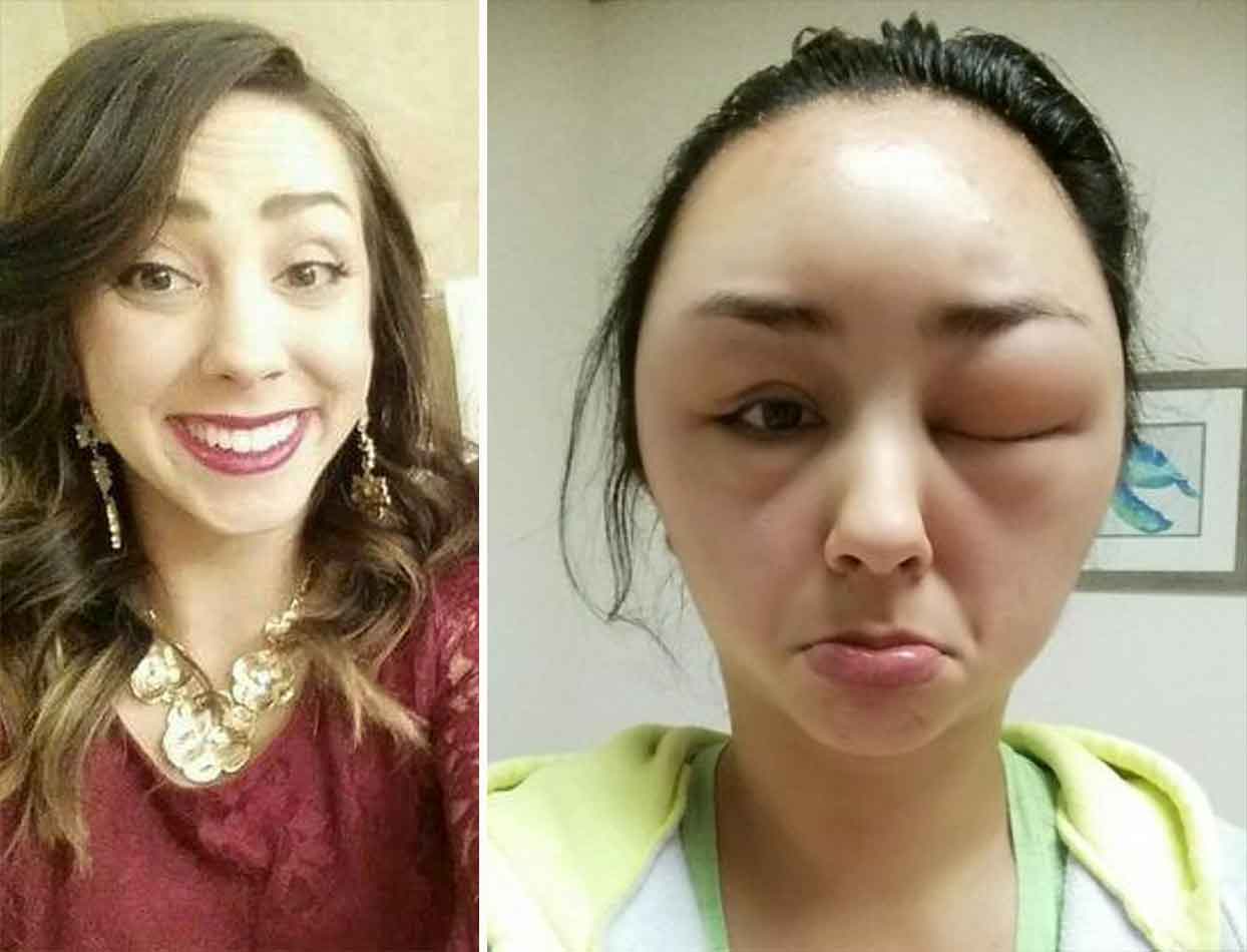 “My friend had a pretty ridiculous allergic reaction to hair dye.”