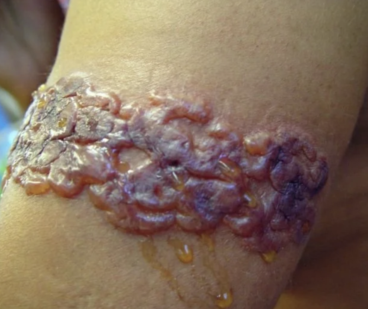 “This was supposed to be a pretty henna wrist tattoo, but an allergic reaction has turned it into an oozing sore.”