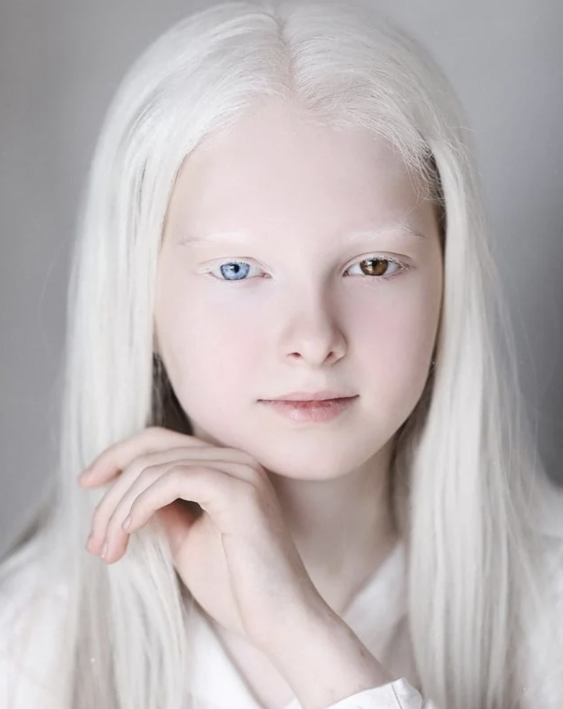 albino woman