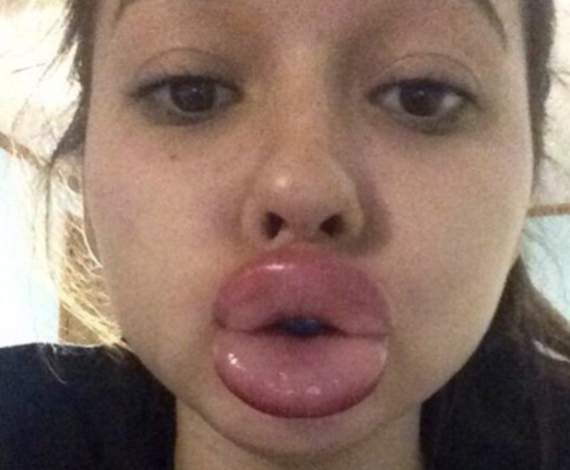 If you’ve ever wanted to look like Kylie Jenner,  but can’t afford the lip filler, then the Kylie Jenner Lip Challenge is for you. Just use suction on the inside of a shot glass until the resulting swelling does the job, and hope that it doesn’t cause immense pain, tissue damage or worse. 