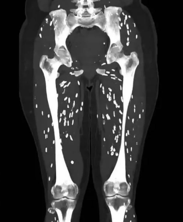 tapeworm ct scan