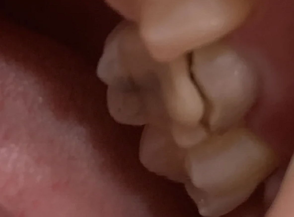 tooth