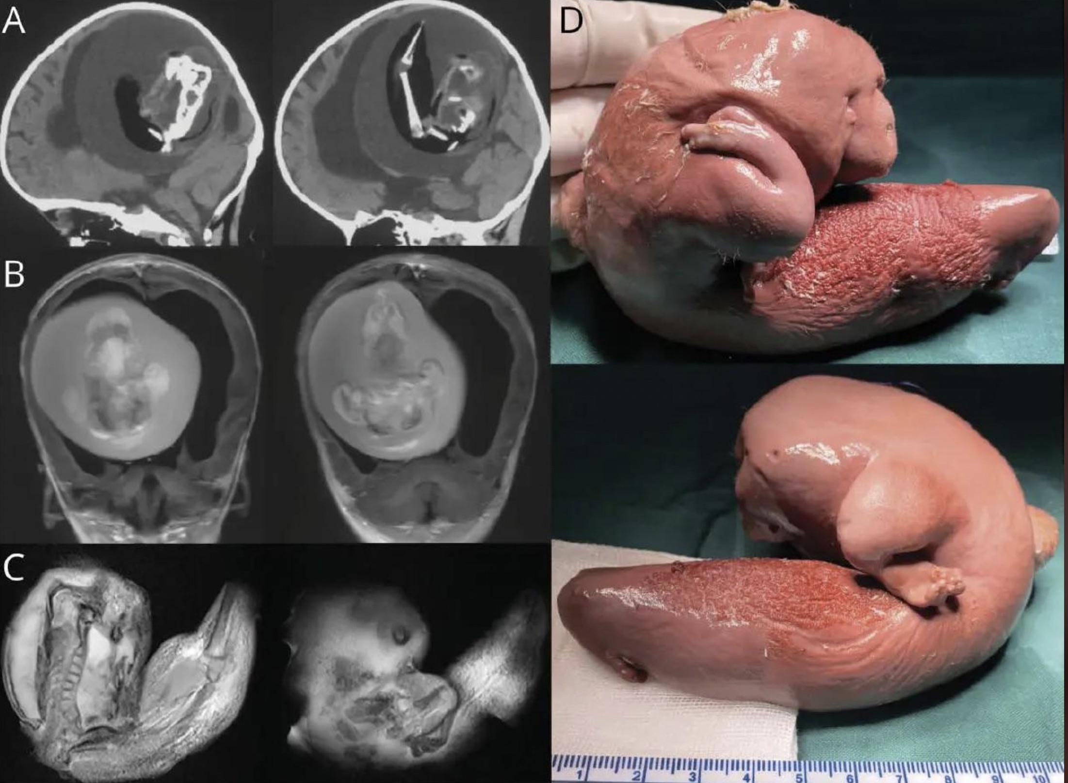 1 year old girl had her twin growing inside her brain - A D B C