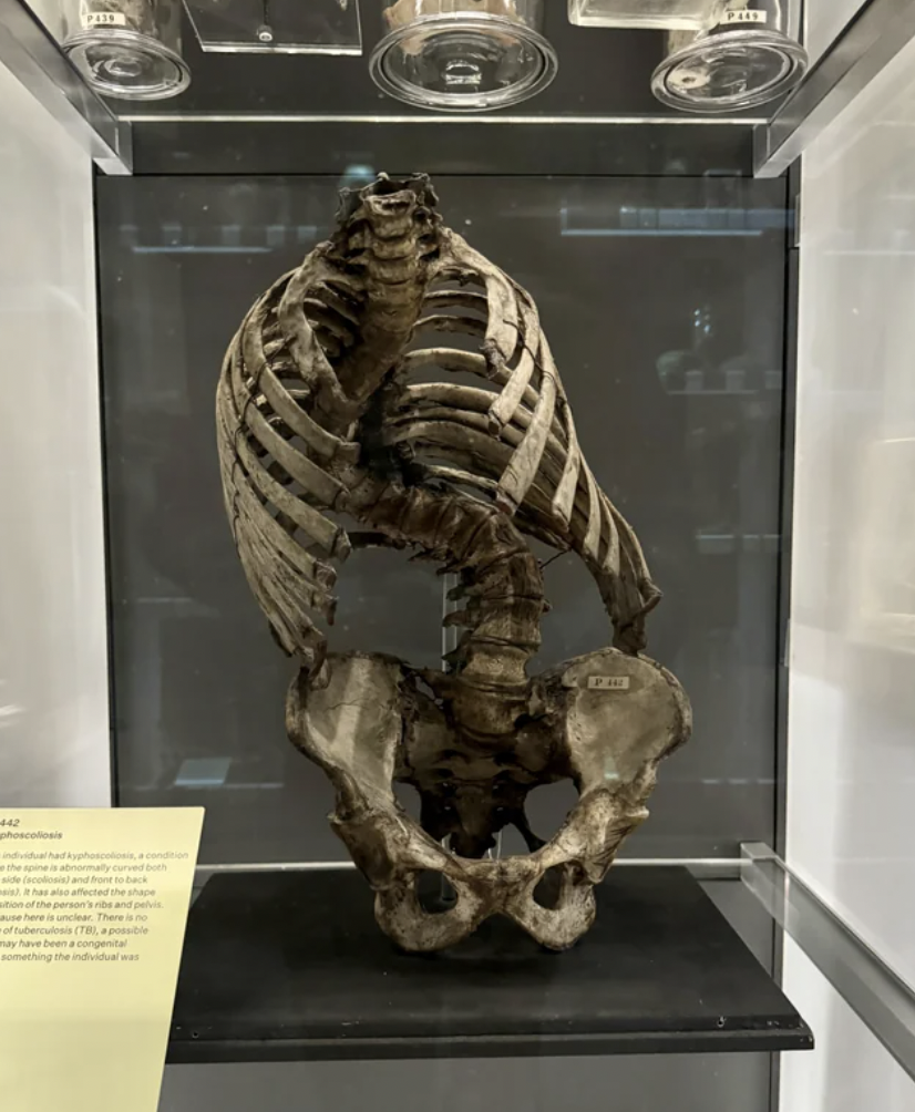 Skeleton of a person with severe scoliosis, Hunterian Museum London.